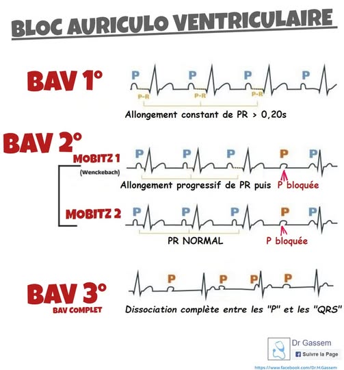 BAV (Bloc auriculo ventriculaire)